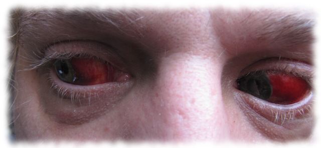 Ulfs blutige Augen am 28. Juni 2011.