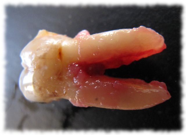 Frisch gezogener Zahn (von einer frühern Extraktion, der heute ist total zerstückelt worden)
