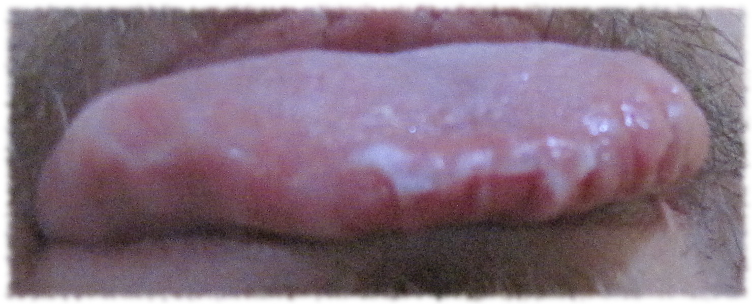 Druckstellen an der Zunge (weißlich)